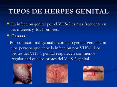 herpes genital mujer